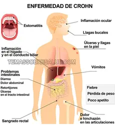 EnfermedadCrohn.jpg
